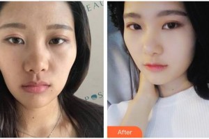 成都艾美醫(yī)療美容門診部蔣學江整形價格表附抗衰老—緊致祛皺—熱瑪吉案例展示