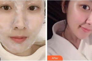 成都漢密爾頓美容醫(yī)院石曉軍整形價格表附點陣激光案例展示