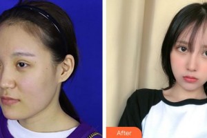 成都華顏醫(yī)療美容門診部王平整形價格表附鼻部手術 面部吸脂案例展示