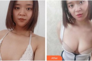成都金榮醫(yī)學美容診所周金芳整形價格表附濃縮豐胸真實案例展示