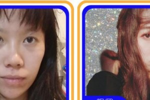 成都金榮醫(yī)學美容診所葛冬梅整形價格表附鼻部手術脂肪填充案例展示