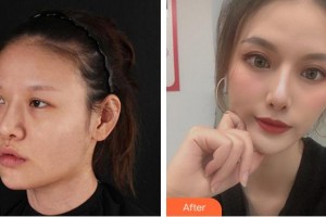 成都艾尚醫(yī)學(xué)美容門診部張艷峰整形價(jià)格表附眼部綜合案例展示