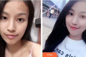 成都恒博醫(yī)院整形美容中心白振華整形價(jià)格表附鼻部綜合案例展示