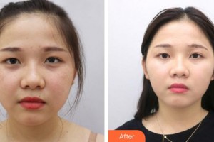 成都恒博醫(yī)院整形美容中心廖恒利整形價格表附祛斑案例展示