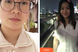 廣州華美醫(yī)療美容醫(yī)院鄭載浩整形價格表附溶脂案例展示