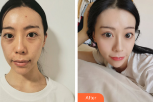 廣州華美醫(yī)療美容醫(yī)院金智妍整形價格表附面部埋線提升案例展示