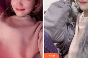 廣州海峽醫(yī)學整形美容醫(yī)院魏巍整形價格表附超聲波潔牙案例展示