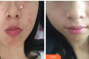 成都濟(jì)慈德美醫(yī)療美容門診部鄭光靜整形價格表附激光點痣案例展示