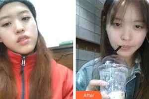 成都俏百顏美容整形醫(yī)院張強(qiáng)整形價格表附自體脂肪全臉填充案例展示