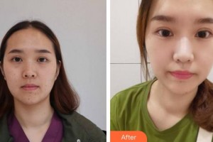 成都泊菲凱莉醫(yī)學(xué)整形美容醫(yī)院任小東整形價格表附褐青色痣案例展示