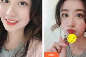 成都嬌點醫(yī)學(xué)美容醫(yī)院戴桂華整形價格表附假體豐眉弓案例展示