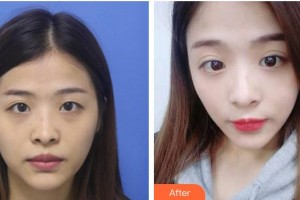 成都晶膚醫(yī)學(xué)美容醫(yī)院鄭勝國整形價格表附不開刀雙眼皮案例展示