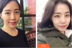 成都艾美薇醫(yī)療美容門診部何玲整形價格表附祛斑祛痘案例展示
