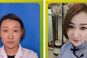 成都瑞美薈醫(yī)療美容醫(yī)院胡杰整形價格表附眼部綜合案例展示
