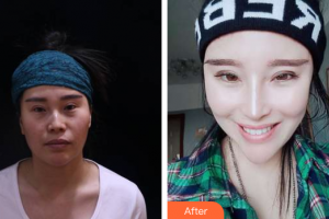 廣州海峽醫(yī)學整形美容醫(yī)院周江整形價格表附鼻部手術案例展示