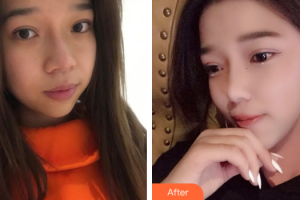 廣州晨曦醫(yī)療美容醫(yī)院錢莎整形價格表附超激光美膚祛斑案例展示