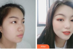 成都科思研醫(yī)療美容診所趙澤方整形價格表附補(bǔ)水保濕案例展示
