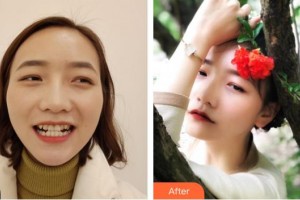 成都德頓齒科診所熊江整形價格表附牙綜合案例展示