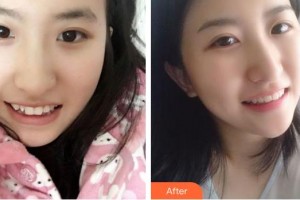 成都拉斐爾口腔門診部黎佶整形價格表附牙齒矯正案例展示