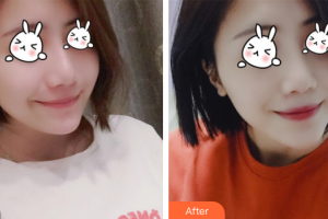 廣州康華清醫(yī)學美容門診部曾海燕整形價格表附無針水光案例展示