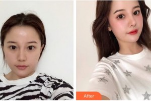 成都愛迪眼科醫(yī)院譚永福整形價格表附眼部手術案例展示