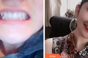 成都華陽微笑口腔診所王冰蓉整形價(jià)格表附牙齒矯正案例展示