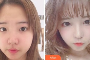成都中醫(yī)大銀海眼科醫(yī)院潘學會整形價格表附眼部整形案例展示