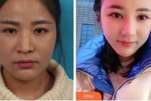 成都中醫(yī)大銀海眼科醫(yī)院劉小虎整形價格表附眼鼻部手術案例展示