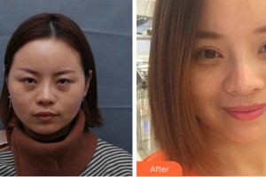 成都中醫(yī)大銀海眼科醫(yī)院文娟住院醫(yī)師整形價格表附眼部綜合案例展示