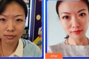 成都新視界眼科醫(yī)院余小清整形價格表附5s重瞼術+超微創(chuàng)開內眥案例展示