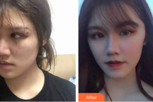 廣州中科美整形醫(yī)院鄧詠整形價格表附人魚膠提升術案例展示