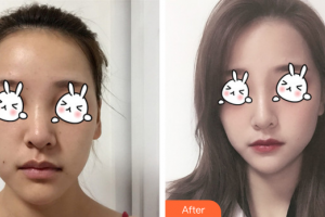 廣州尚美善造美容醫(yī)院李青姍整形價格表附無針水光案例展示