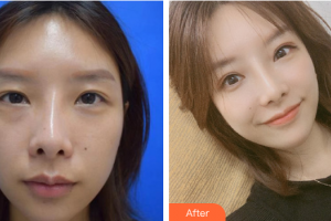 廣州尚美善造美容醫(yī)院葉蓓慧整形價格表附雙眼皮修復案例展示