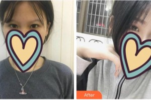 福建醫(yī)科大學(xué)附屬第二醫(yī)院眼科中心許鍛煉整形價格表附眼部綜合案例展示