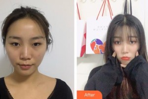 福建醫(yī)科大學(xué)附屬第二醫(yī)院眼科中心高瑩瑩整形價格表附眼部整形案例展示