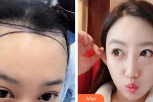 福州中意醫(yī)療美容門診部黃鎮(zhèn)熙整形價格表附發(fā)際線種植案例展示