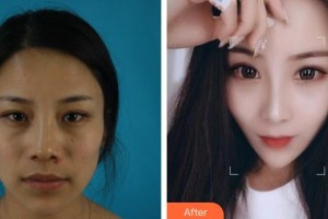 福州海峽美容醫(yī)院王英勇整形價格表附鼻部手術(shù)案例展示