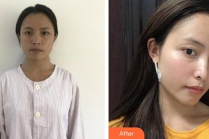 福州海峽美容醫(yī)院曹海峰整形價格表附面部吸脂案例展示