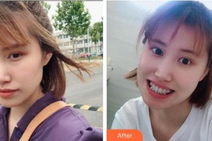 福州美萊華美美容醫(yī)院鄧誠整形價格表附金屬托槽牙齒矯正案例展示