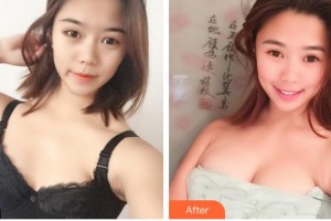 福州曙光整形美容醫(yī)院馮光珍整形價格表附濃縮豐胸真實案例展示