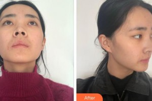 福州名韓整形美容醫(yī)院光整形價格表附鼻部手術案例展示