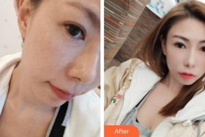 福州格萊美醫(yī)療美容醫(yī)院黃俊俊整形價格表附激光美膚激光案例展示