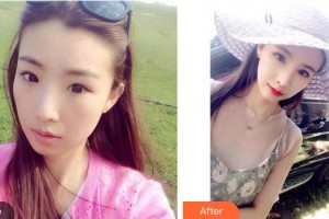 福州隆美爾整形美容醫(yī)院郭永年整形價格表附鼻部手術(shù)案例展示
