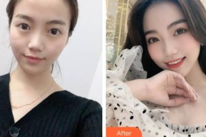福州愛思特比華利整形美容醫(yī)院蘇碧鳳整形價格表附埋線雙眼皮案例展示