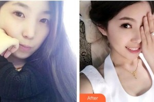 福州美萊華美美容醫(yī)院劉欣整形價格表附時代天使矯正案例展示