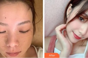福州市第一醫(yī)院整形美容科楊青青整形價格表附“6D埋線提升”重返年輕案例展示