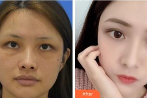 福州市鼓樓醫(yī)院整形美容中心蔡超秋整形價格表附埋線提升案例展示