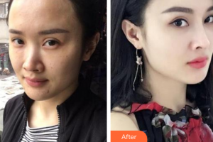 廣州尚美善造美容醫(yī)院李瓊整形價格表附熱瑪吉頸部體驗(yàn)案例展示