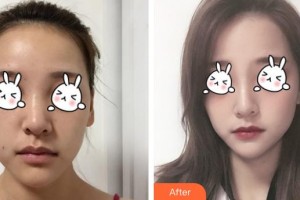 福州美萊華美美容醫(yī)院陳力楊整形價格表附下巴注射結合嗨體、線材改良嘟案例展示
