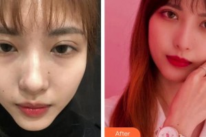 福州海峽美容醫(yī)院隋長青整形價格表附眼部綜合案例展示